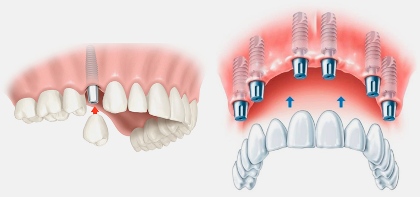 implantes dentarios em horizonte ceara